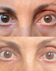 Dark Circles Microdissolving Patches