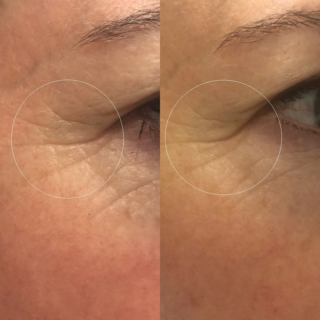 Fine Lines Mirodissolving Patches