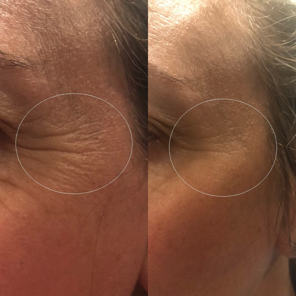 Fine Lines Mirodissolving Patches
