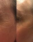 Fine Lines Mirodissolving Patches