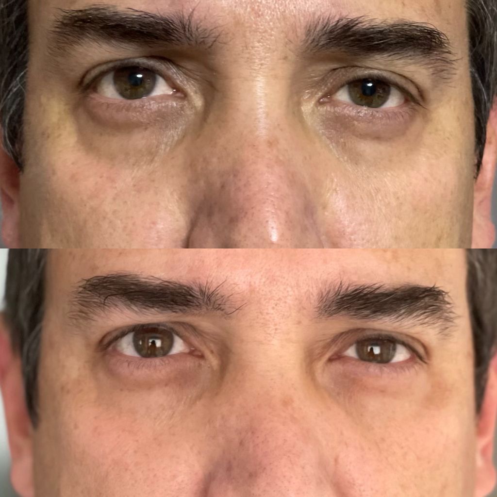 Dark Circles Microdissolving Patches